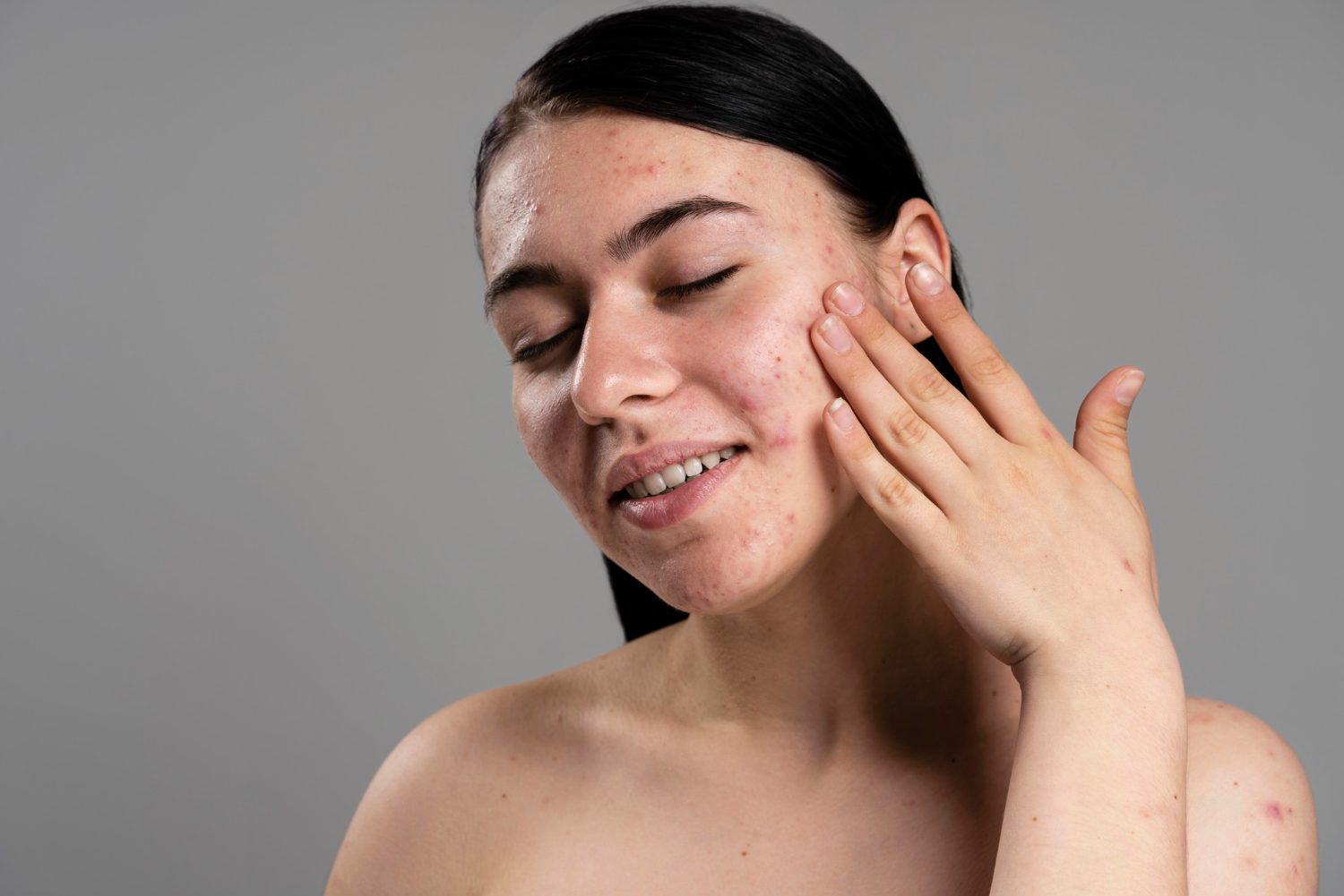 Acne & Scarring at Evora