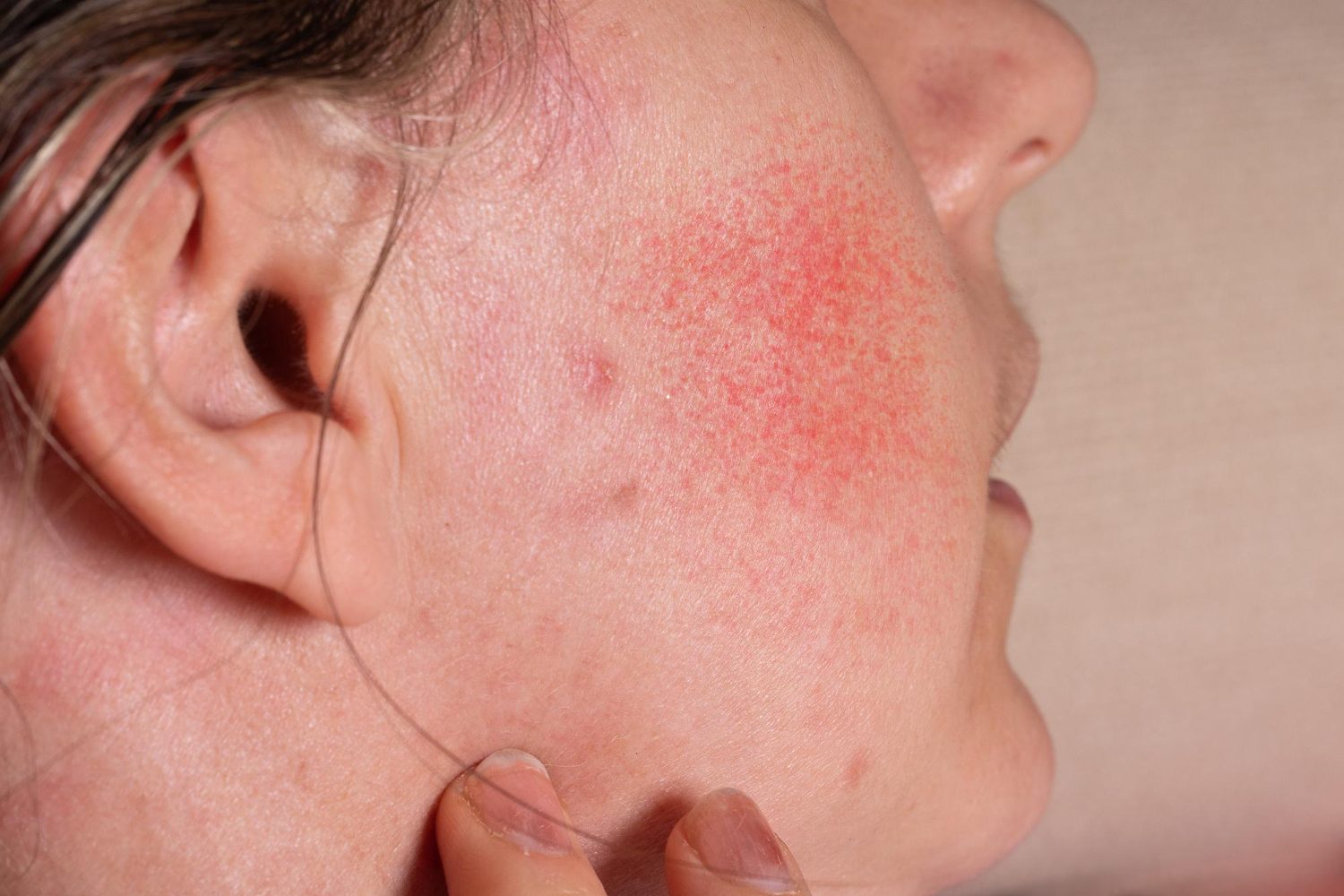 Redness & Rosacea at Evora