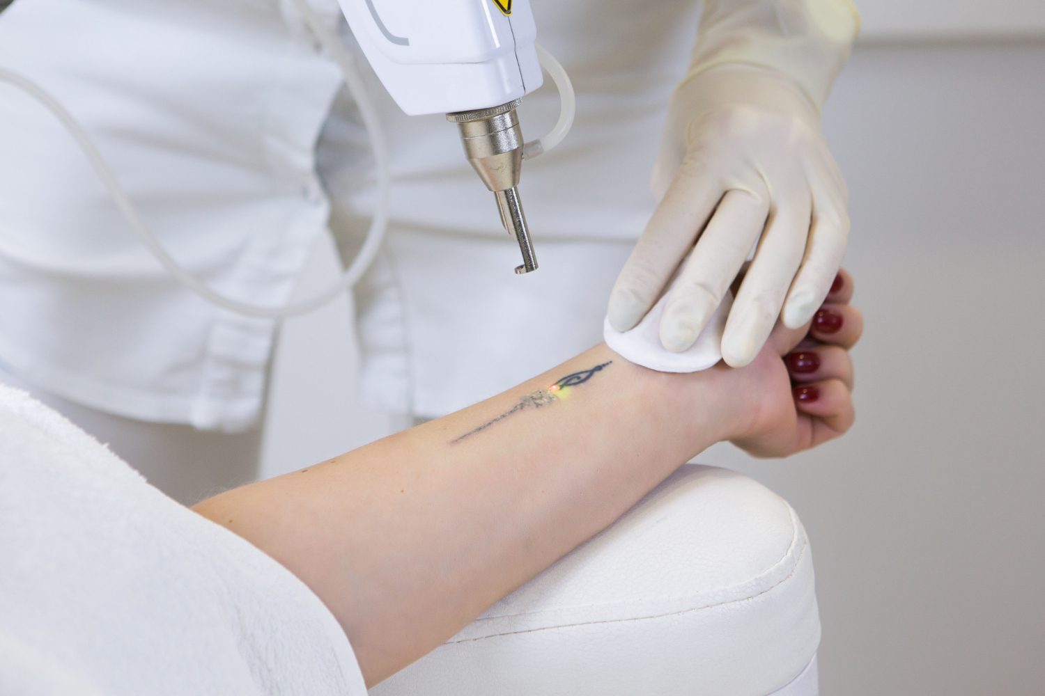 Tattoo Removal at Evora