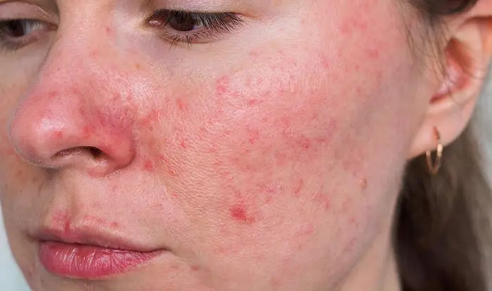 Redness & Rosacea