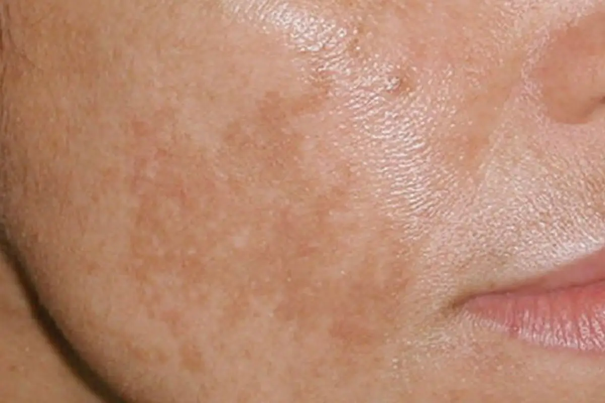 Brown Spots & Pigmentation