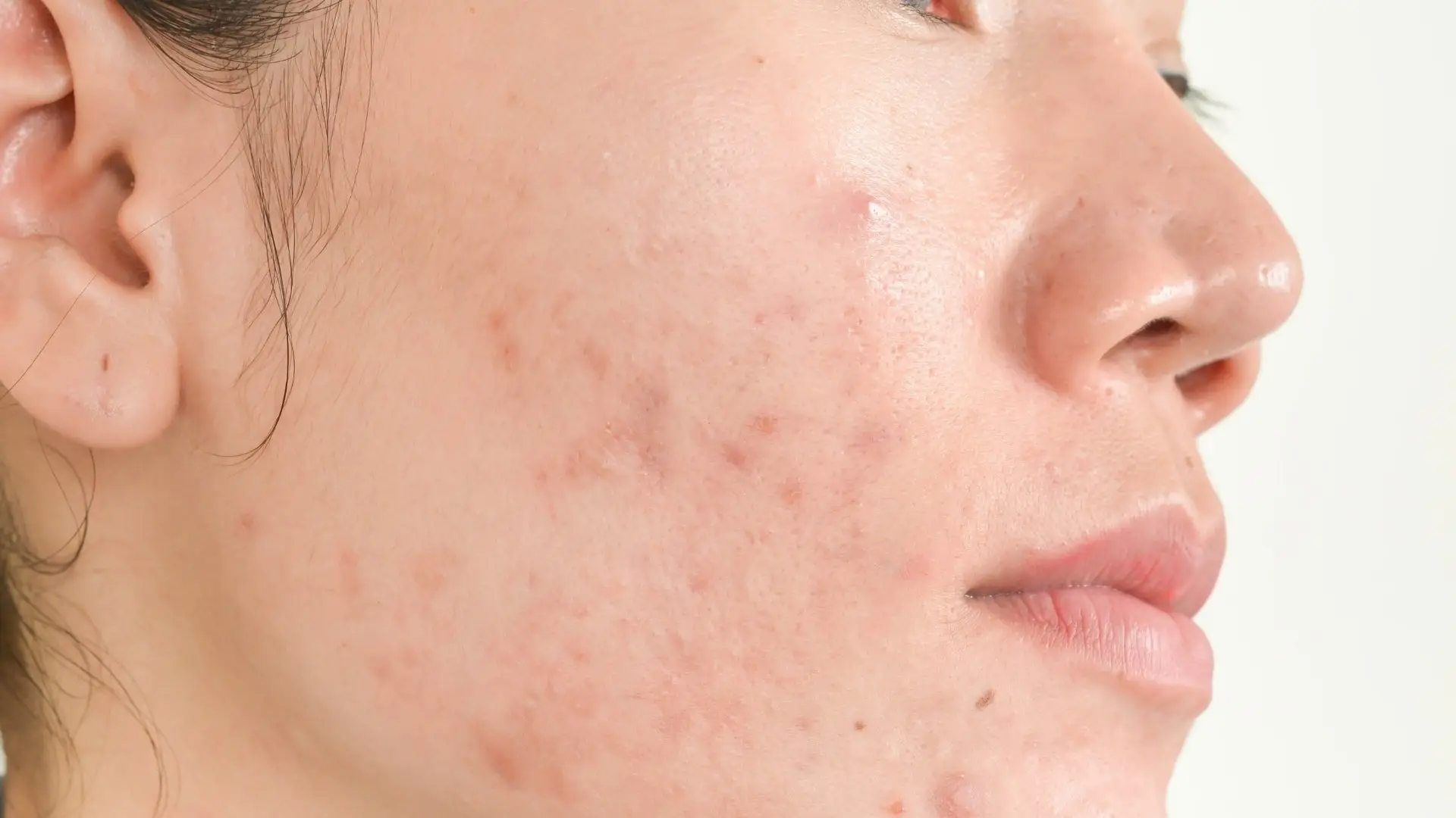 Acne & Scarring
